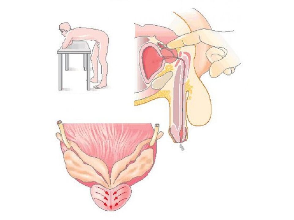 Prostate massage technique by a doctor to analyze the secretion